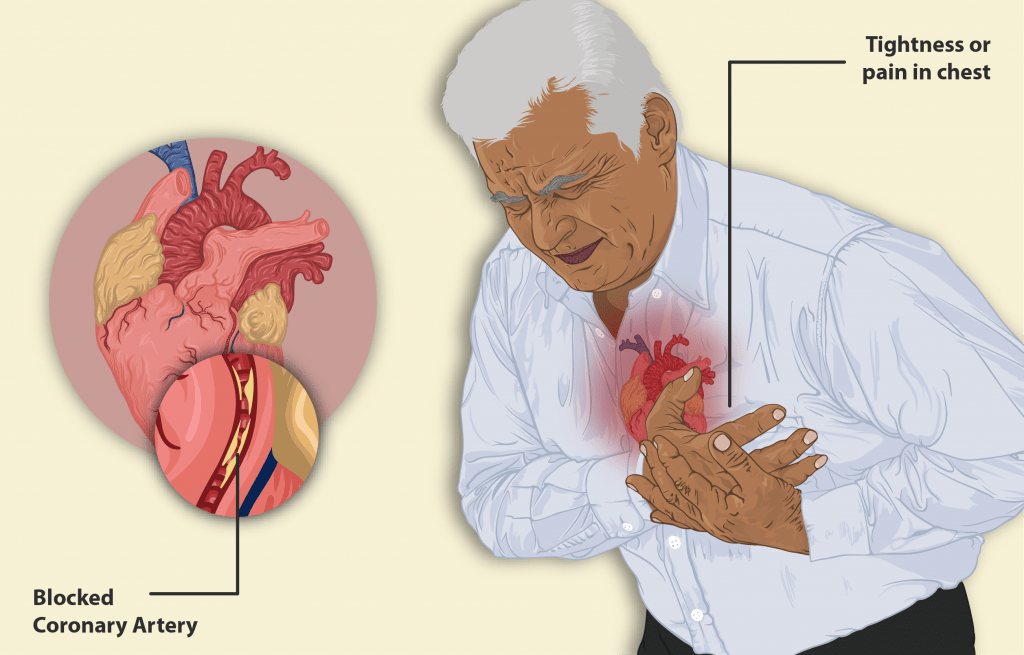 Five Body Pains That Can Indicate a Heart&nbsp;Attack